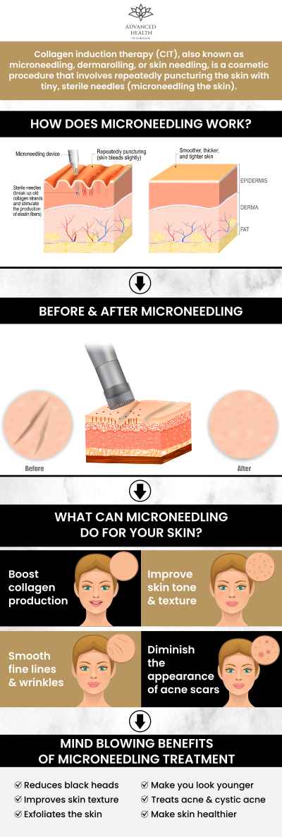Discover how microneedling can enhance your skin’s health at Advanced Health of Oakbrook, led by Dr. Christopher Orenczak. This innovative treatment stimulates collagen production, improving skin texture, reducing fine lines, and boosting overall radiance. Ideal for those seeking smoother, firmer, and rejuvenated skin, microneedling offers minimal downtime and visible results. Our team provides personalized care to help you achieve healthier, glowing skin. For more information, contact us today or schedule an appointment online. Visit our clinic conveniently located at 17W705 Butterfield Road Suite E, Oakbrook Terrace, IL 60181. Discover how microneedling can enhance your skin’s health at Advanced Health of Oakbrook, led by Dr. Christopher Orenczak. This innovative treatment stimulates collagen production, improving skin texture, reducing fine lines, and boosting overall radiance. Ideal for those seeking smoother, firmer, and rejuvenated skin, microneedling offers minimal downtime and visible results. Our team provides personalized care to help you achieve healthier, glowing skin. For more information, contact us today or schedule an appointment online. Visit our clinic conveniently located at 17W705 Butterfield Road Suite E, Oakbrook Terrace, IL 60181.